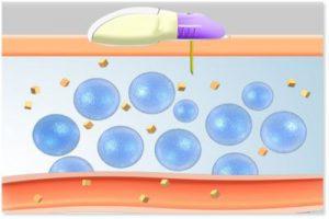 Sistema Minimed 640G